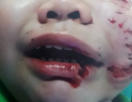 Cháu Trần Trường T. (3 tuổi, ở huyện Củ Chi, TP.HCM) bị chó nhà cắn, được gia đình chuyển đến trong tình trạng nhiều vết thương chằng chịt nham nhở tập trung chủ yếu trên vùng mặt trái, phải khâu 200 mũi. Cháu Trần Trường T. (3 tuổi, ở huyện Củ Chi, TP.HCM) bị chó nhà cắn, được gia đình chuyển đến trong tình trạng nhiều vết thương chằng chịt nham nhở tập trung chủ yếu trên vùng mặt trái, phải khâu 200 mũi.