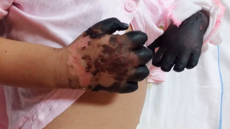 Xot thuong be gai bi hoai tu tu chi do nhiem benh than hiem gap hinh anh 1