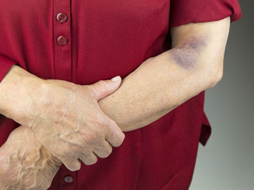 Da đột nhiên bị bầm tím không hẳn là do va đập Da dot nhien bi bam tim khong han la do va dap