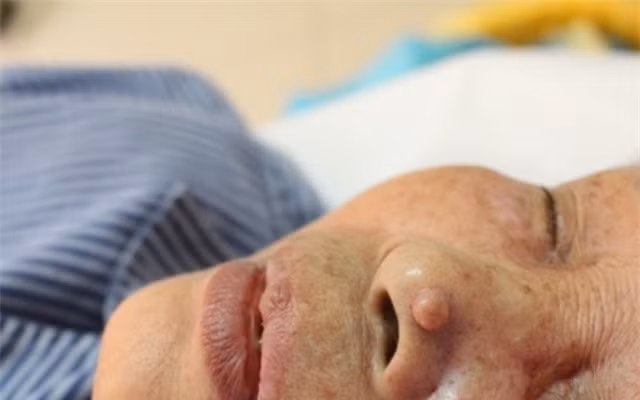 Cảnh báo gia tăng bệnh nhân ung thư da, nhiều người không biết mình mắc bệnh-3