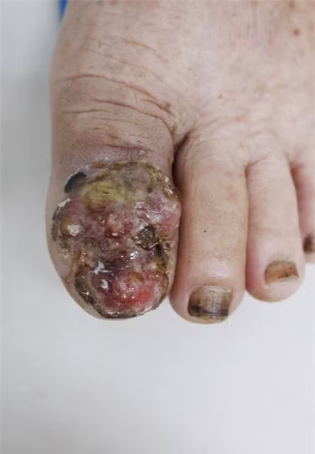 Cảnh báo gia tăng bệnh nhân ung thư da, nhiều người không biết mình mắc bệnh-2