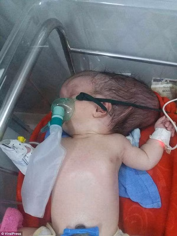 Phần đầu lõm sâu nhưng phía sau đầu của bé Ah lại phình to bất thường