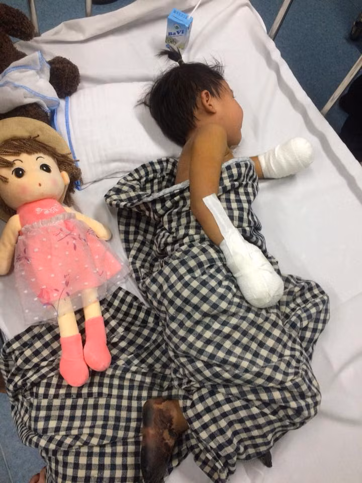 Xot thuong be gai bi hoai tu tu chi do nhiem benh than hiem gap hinh anh 2