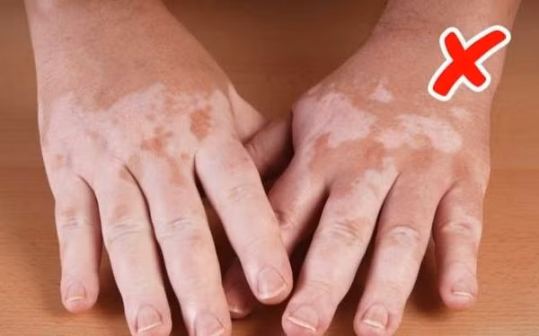 dau hieu bat thuong tren da-phunutoday1