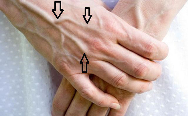Gân xanh nổi lên chằng chịt ở những chỗ này cảnh báo căn bệnh nguy hiểm 