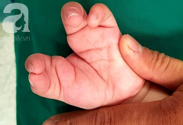 Cậu bé 2 tuổi ở TP.HCM mắc “hội chứng tôm hùm” vô cùng hiếm gặp