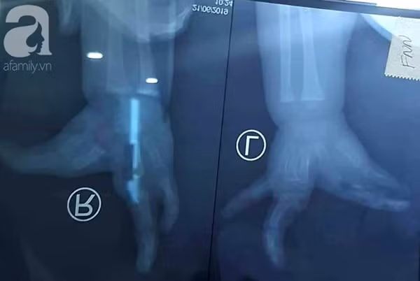 TP.HCM: Mẹ nghẹn ngào khi con trai 2 tuổi mắc hội chứng tôm hùm vô cùng hiếm gặp khiến tay chân dị dạng-2