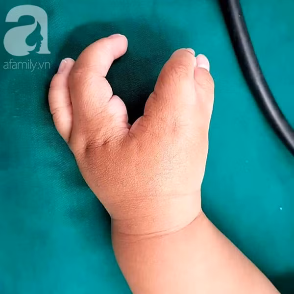 TP.HCM: Mẹ nghẹn ngào khi con trai 2 tuổi mắc hội chứng tôm hùm vô cùng hiếm gặp khiến tay chân dị dạng-3