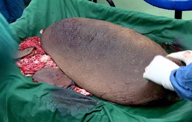  Khối u gần 13 kg được cắt bỏ khỏi cơ thể Saidalavi. 