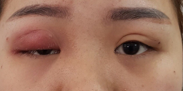 Nhấn mí ở spa, cô gái suýt mù mắt vì kim gãy đâm vào nhãn cầu ảnh 2 Nhấn mí ở spa, cô gái suýt mù mắt vì kim gãy, gần đâm thủng nhãn cầu-2