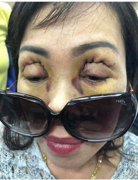 Nhấn mí ở spa, cô gái suýt mù mắt vì kim gãy đâm vào nhãn cầu ảnh 3 Nhấn mí ở spa, cô gái suýt mù mắt vì kim gãy, gần đâm thủng nhãn cầu-4