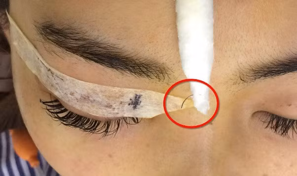 Nhấn mí ở spa, cô gái suýt mù mắt vì kim gãy, gần đâm thủng nhãn cầu-1