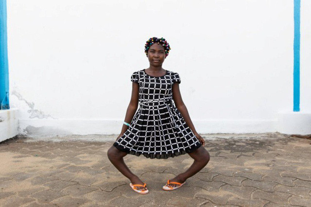 Gặp cô bé có đôi chân cong vẹo đến gần 90 độ ảnh 1 Julienne và đôi chân vòng kiềng dị dạng