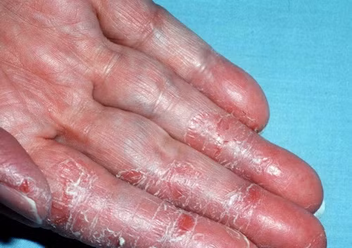 Bong da lòng bàn tay.