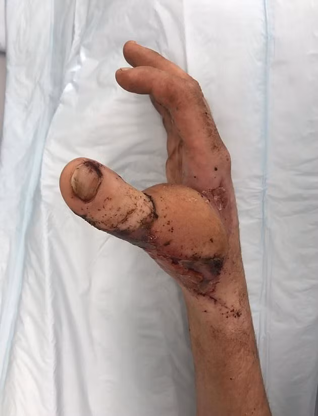 Cận cảnh bàn tay sau ca cấy ghép kỳ lạ