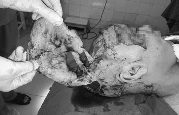 Cô gái trẻ bị lột sạch da đầu do tóc cuốn vào máy ép tôn Cô gái trẻ bị lột sạch da đầu do tóc cuốn vào máy ép tôn