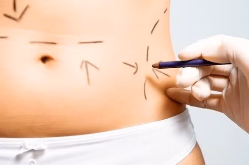  Quy trình hút mỡ bụng như thế nào, tại sao lại tử vong? 