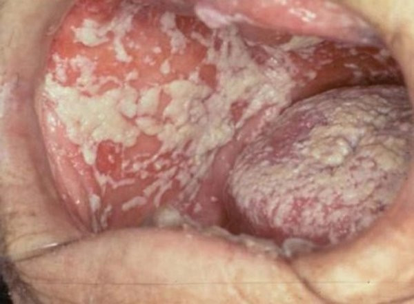 Miệng bệnh nhân mốc trắng từng mảng, biết lý do bác sĩ còn choáng hơn ảnh 2 bac si hai hung khi thay mieng benh nhan moc trang tung mang, biet ly do con choang hon - 4