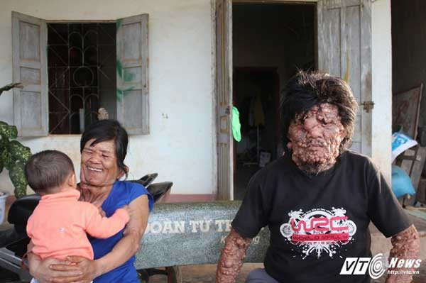 Ông Tê cùng người con gái có khuôn mặt biến dạng.