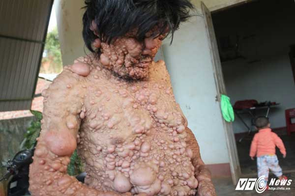 Khối u lạ mọc khắp cơ thể người đàn ông mệnh danh 