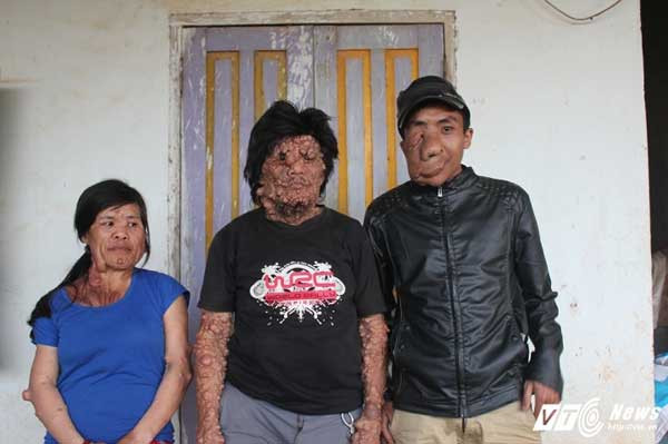 3 người trong gia đình ông Tê với nhiều dị tật trên cơ thể.
