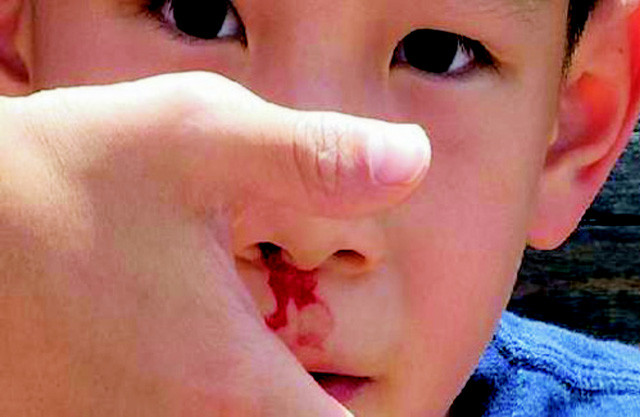 Chảy máu cam ở trẻ em: xử trí và phòng ngừa ảnh 1