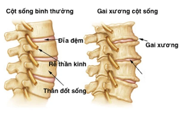 Hình ảnh bệnh gai đôi cột sống.