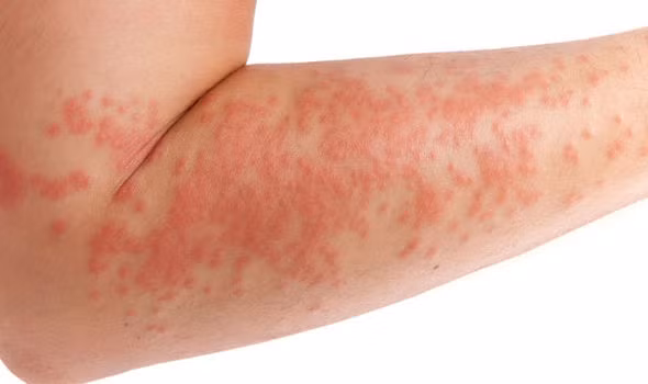 Những căn bệnh ngoài da không ai có thể tránh khỏi