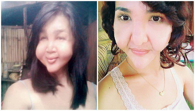 Đôi bạn thân cùng tiến: Rủ nhau phẫu thuật thẩm mỹ chui, đến lúc biến dạng cả khuôn mặt cũng có nhau - Ảnh 4. Đôi bạn thân cùng tiến: Rủ nhau phẫu thuật thẩm mỹ chui, đến lúc biến dạng cả khuôn mặt cũng có nhau - Ảnh 4.