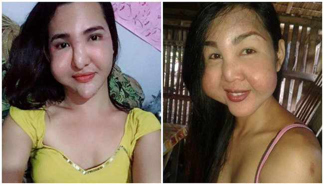 Đôi bạn thân cùng tiến: Rủ nhau phẫu thuật thẩm mỹ chui, đến lúc biến dạng cả khuôn mặt cũng có nhau - Ảnh 3. Đôi bạn thân cùng tiến: Rủ nhau phẫu thuật thẩm mỹ chui, đến lúc biến dạng cả khuôn mặt cũng có nhau - Ảnh 3.