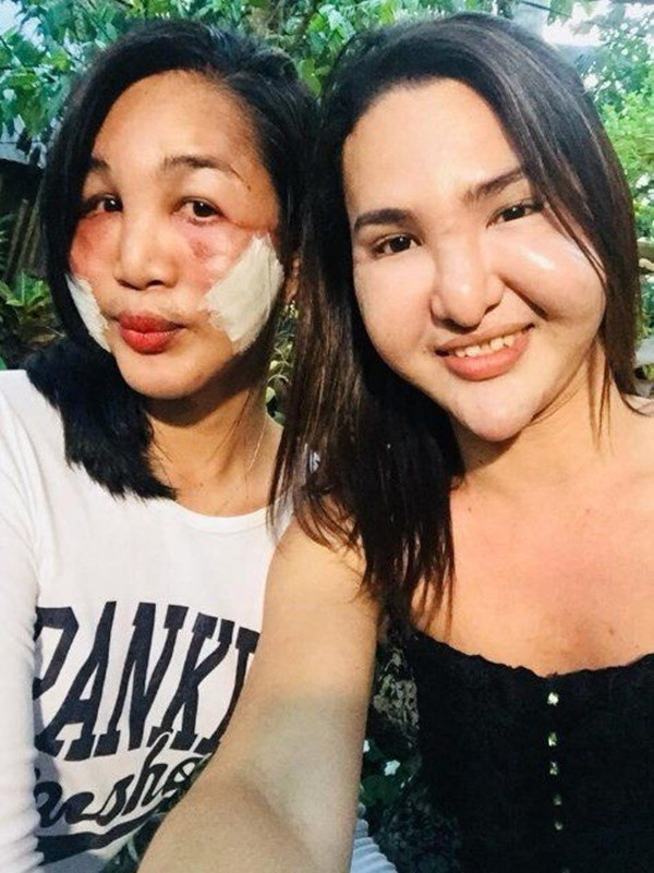 Đôi bạn thân cùng tiến: Rủ nhau phẫu thuật thẩm mỹ chui, đến lúc biến dạng cả khuôn mặt cũng có nhau - Ảnh 1. Đôi bạn thân cùng tiến: Rủ nhau phẫu thuật thẩm mỹ chui, đến lúc biến dạng cả khuôn mặt cũng có nhau - Ảnh 1.