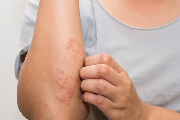 Phát ban không rõ nguyên nhân là dấu hiệu cảnh báo ung thư máu.