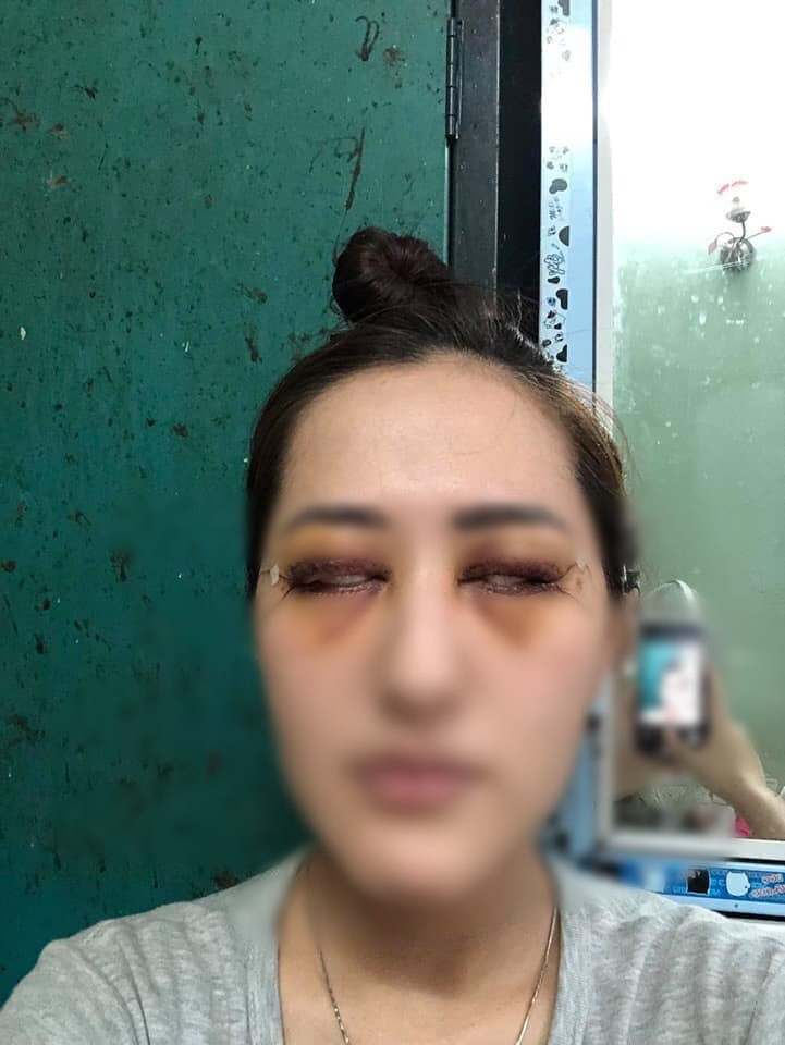 Pha cắt mí đi vào lòng đất: Dân mạng gọi đó là chết không nhắm được mắt-6