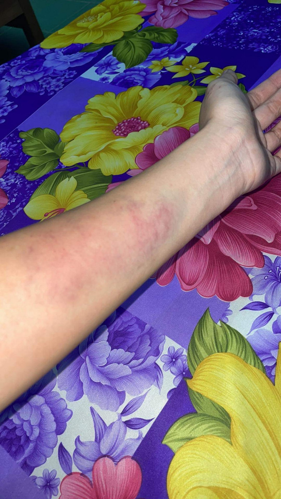 Thiên Ân bầm tím người khi thực hiện thử thách tại Sao nhập ngũ 2022. Thiên Ân bầm tím người khi thực hiện thử thách tại Sao nhập ngũ 2022.