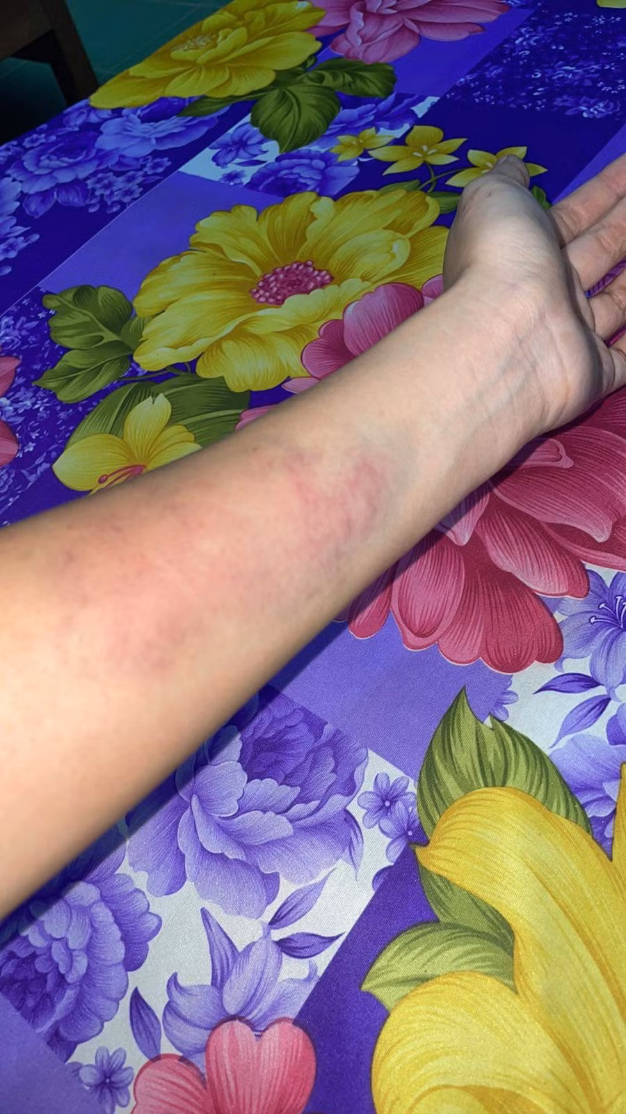 Thiên Ân bầm tím người khi thực hiện thử thách tại Sao nhập ngũ 2022.