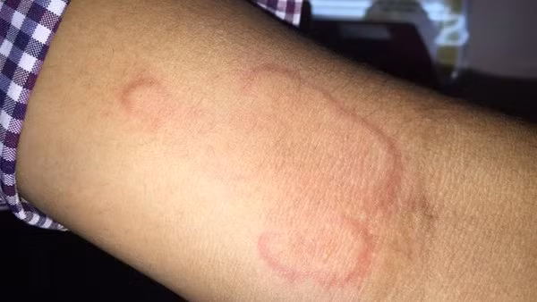 Thường xuyên chăm hoa, người phụ nữ hốt hoảng vì ho khạc ra giun lúc nhúc