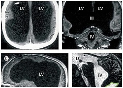 Mất 90% não, người đàn ông vẫn sống khỏe