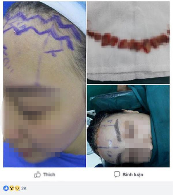 Sửa mũi cắt môi “xưa rồi”, chị em bây giờ rủ nhau làm đẹp kinh dị thế này ảnh 1 Sửa mũi cắt môi đã là gì, chị em bây giờ còn rủ nhau đi cắt da đầu để...-1