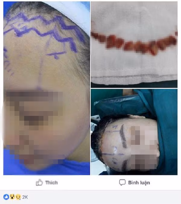 Sửa mũi cắt môi “xưa rồi”, chị em bây giờ rủ nhau làm đẹp kinh dị thế này ảnh 1 Sửa mũi cắt môi đã là gì, chị em bây giờ còn rủ nhau đi cắt da đầu để...-1