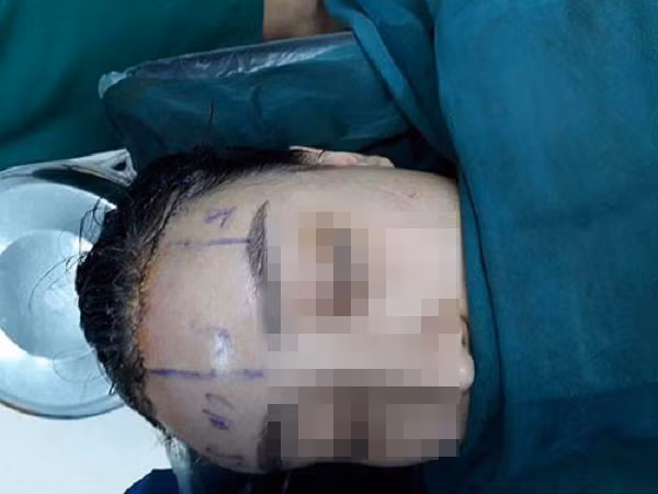 Sửa mũi cắt môi “xưa rồi”, chị em bây giờ rủ nhau làm đẹp kinh dị thế này ảnh 4 Sửa mũi cắt môi đã là gì, chị em bây giờ còn rủ nhau đi cắt da đầu để...-4