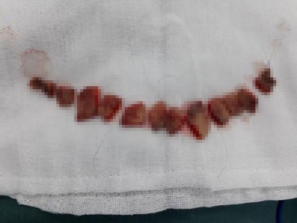 Sửa mũi cắt môi “xưa rồi”, chị em bây giờ rủ nhau làm đẹp kinh dị thế này ảnh 3 Sửa mũi cắt môi đã là gì, chị em bây giờ còn rủ nhau đi cắt da đầu để...-3