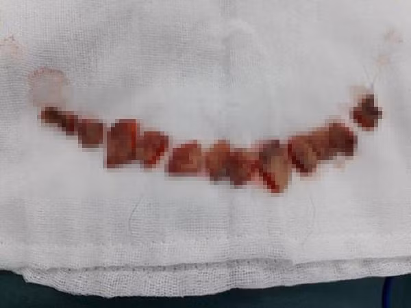 Sửa mũi cắt môi “xưa rồi”, chị em bây giờ rủ nhau làm đẹp kinh dị thế này ảnh 3 Sửa mũi cắt môi đã là gì, chị em bây giờ còn rủ nhau đi cắt da đầu để...-3