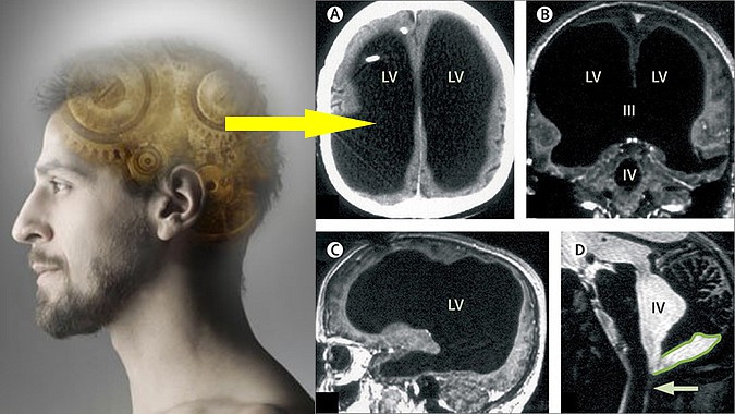 Người đàn ông sống khỏe dù mất 90% não khiến y học bối rối - Hình 1