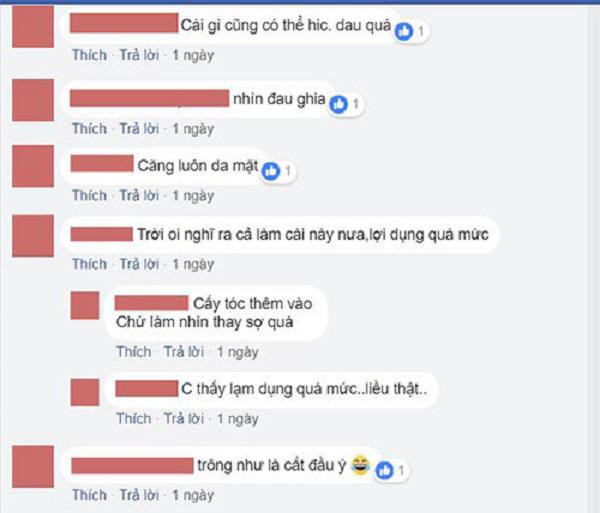 Sửa mũi cắt môi “xưa rồi”, chị em bây giờ rủ nhau làm đẹp kinh dị thế này ảnh 5 Sửa mũi cắt môi đã là gì, chị em bây giờ còn rủ nhau đi cắt da đầu để...-5