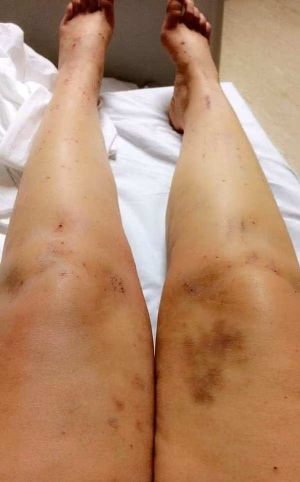 Bà mẹ đột nhiên bị vàng da, toàn thân xước đến chảy máu vì thứ nhiều chị em cũng dùng-2