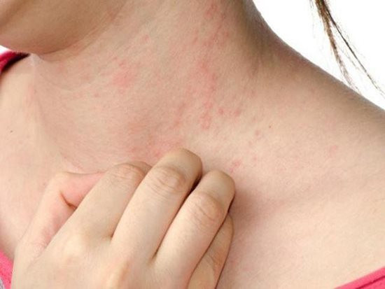 Căn bệnh quái ác khiến nạn nhân không thể tắm hay đổ mồ hôi - Ảnh 3 Căn bệnh quái ác khiến nạn nhân không thể tắm hay đổ mồ hôi - Ảnh 3