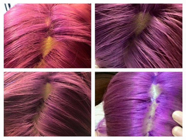 Nổi da gà với tình cảnh cô gái tẩy tóc bị rụng nguyên cả mảng đến mức hói đầu-5