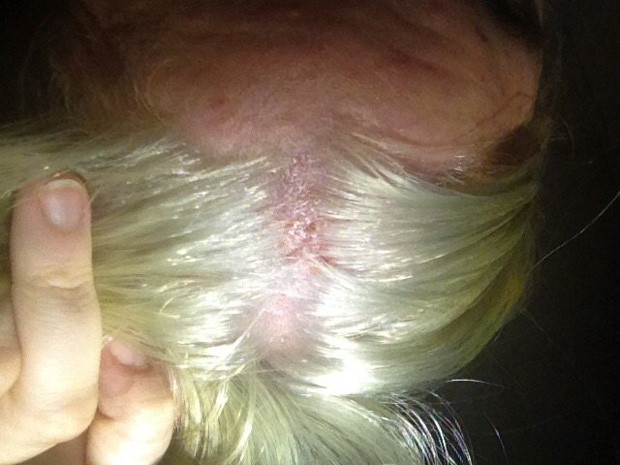 Nổi da gà với tình cảnh cô gái tẩy tóc bị rụng nguyên cả mảng đến mức hói đầu-7