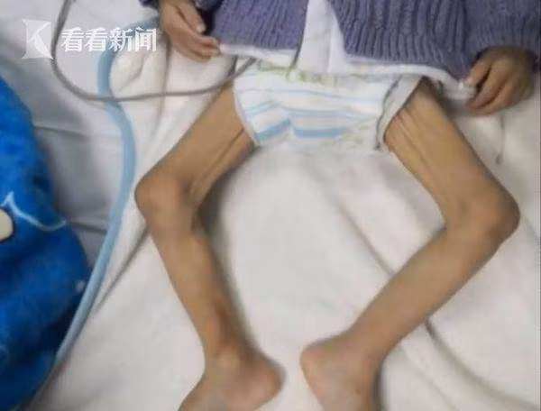 be so sinh chao doi 4,4kg nhung sau mot nam khong ai nhan ra, nguyen nhan qua dang so - 1