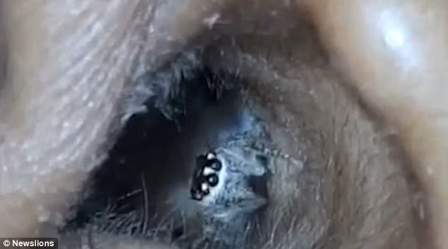 di kham vi dau dau, bac si phat hien nhen nam trong hinh anh 1